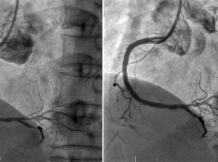 invasive coronary angiography